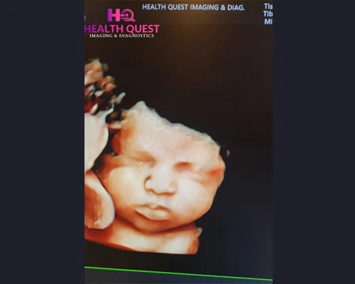 4D Ultrasound In DLF City IV