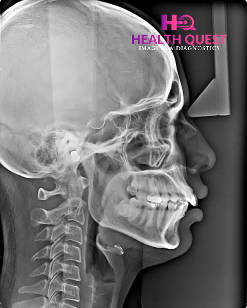 Cephalogram In DLF Phase 1