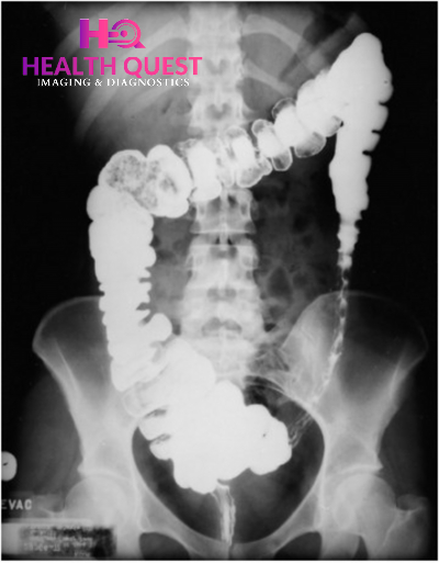 Barium Studies In Ghata