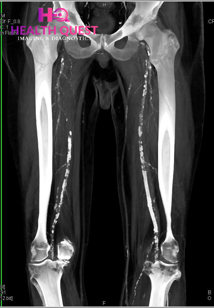 Peripheral Vascular Studies In DLF Phase 2