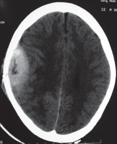 NCCT Brain In DLF Phase 3