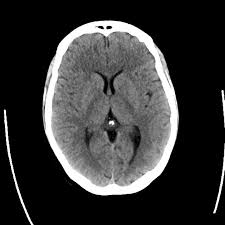 CECT Brain In DLF Phase 2