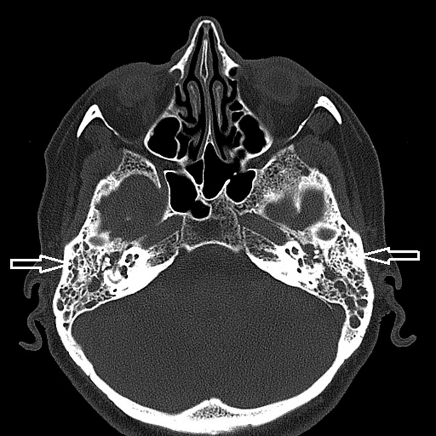 HRCT Temporal Bone In DLF Phase 3