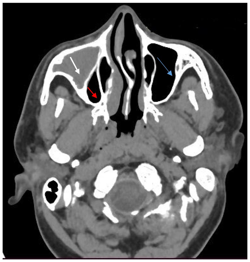 NCCT Nose And PNS In DLF Phase 3