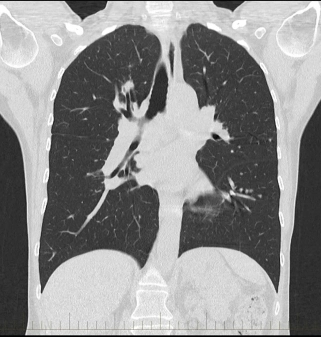 CT Chest In DLF Phase 3