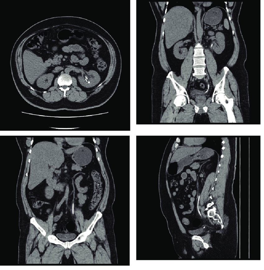 CT KUB In DLF Phase 2