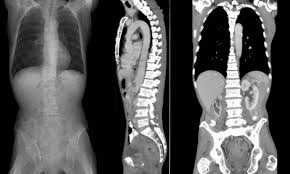 CT Spine In Gurugram Sector 38