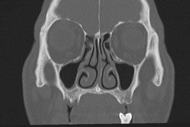 CT PNS In DLF Phase 3