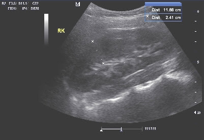 Ultrasound KUB In DLF Phase 2