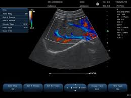 Ultrasound Doopler In DLF Phase 3