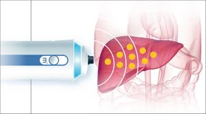 Fibroscan With Cap In Gurugram Sector 38