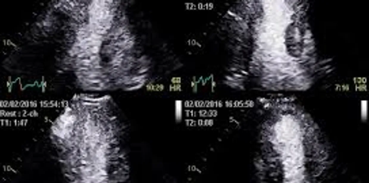 Dobutamine Echo In Gurugram Sector 38