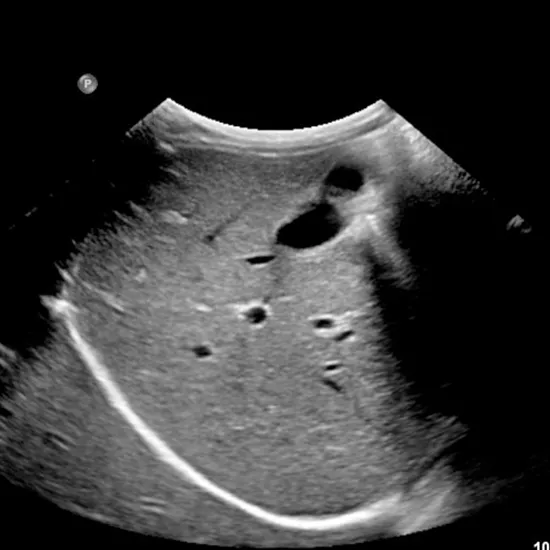 USG Upper Abdomen In DLF Phase 3