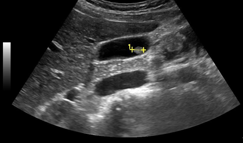 Ultrasound Upper Abdomen In DLF Phase 2