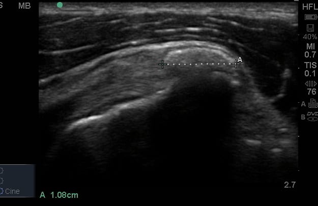 USG Shoulder Joint In DLF Phase 3