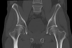 CECT Hip Joint In DLF Phase 2