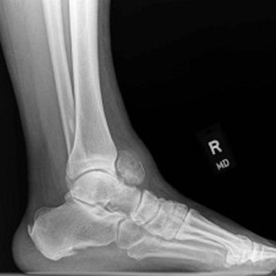 CECT Left Ankle Joint In DLF Phase 2