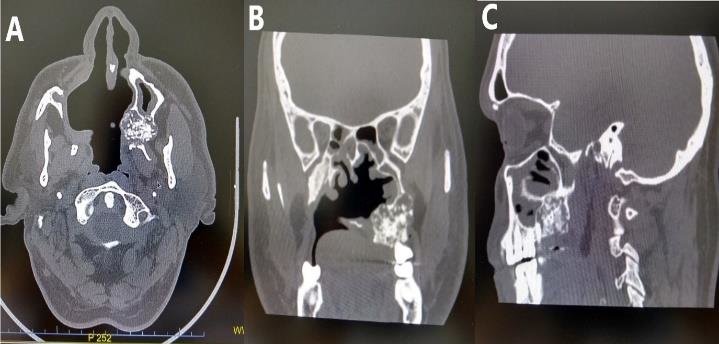 CECTPnsAxail& Coronal In DLF Phase 2