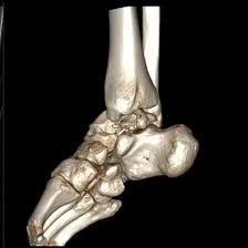 CECT Right Ankle Joint In DLF Phase 2