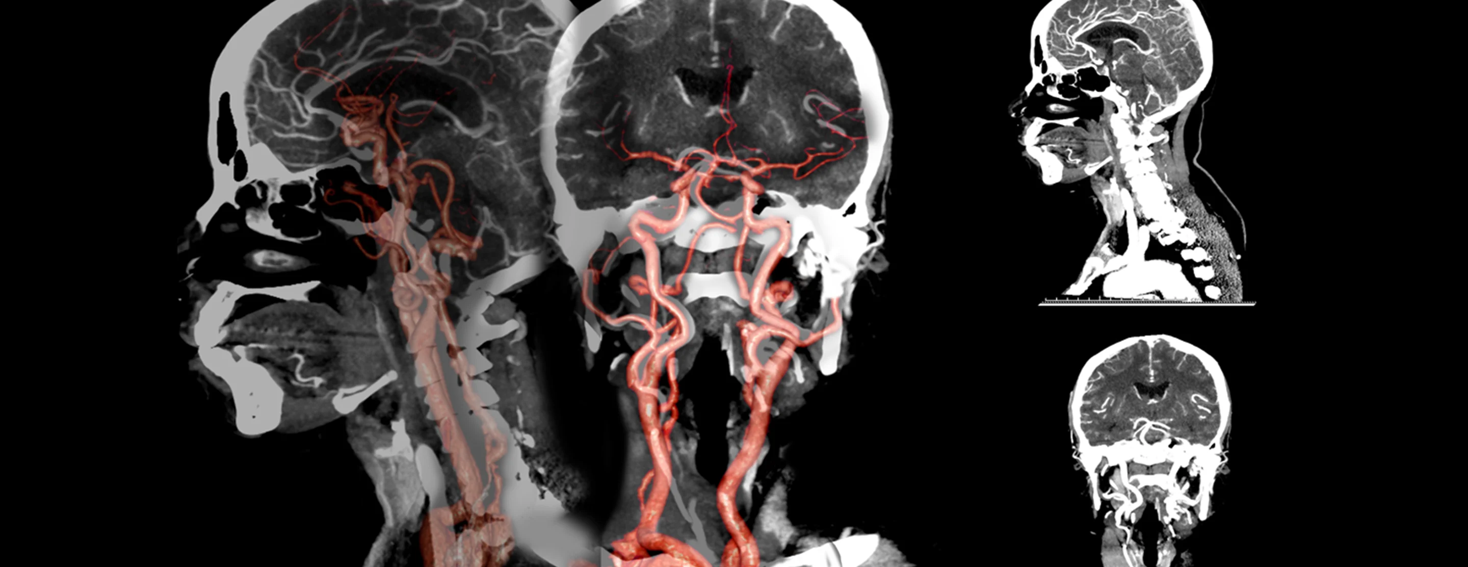 Ct Angio - Cerebral In DLF Phase 3