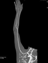 Ct AngioBl Upper Limb In DLF Phase 3