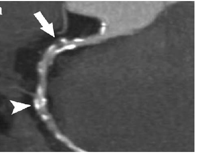 Ct Angio Coronary In Gurugram Sector 38