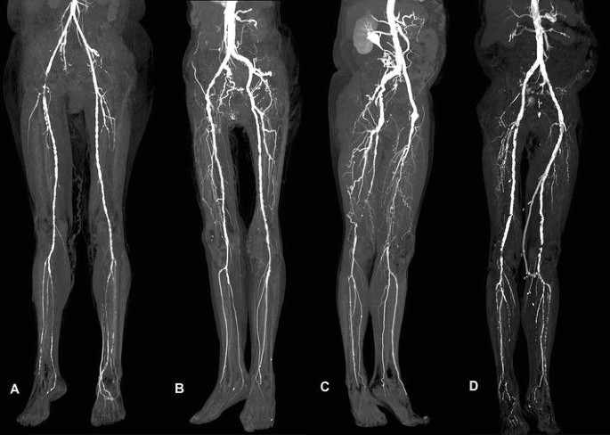 Ct Angio Lower Limb Bilateral In DLF Phase 3