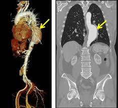 Ct Angio- Thoracic Aorta In DLF Phase 2