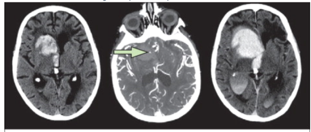 Ct Angiography Brain - Cerebral & Neck In Gurugram Sector 38