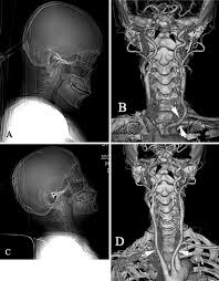 Ct Angioraphy Neck In DLF Phase 2