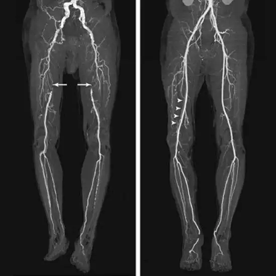 Ct Angioraphy Right Lower Limb In Gurugram Sector 38