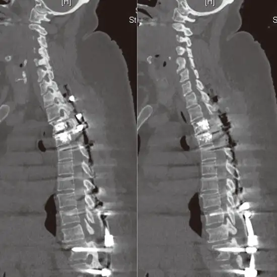 Ct Dorso Lumber Spine With Contrast In DLF Phase 2