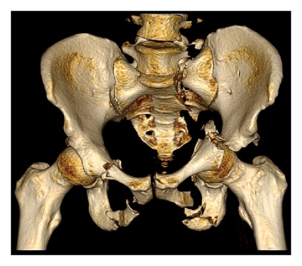 Ct Pelvis With 3d Reconstruction In DLF Phase 3