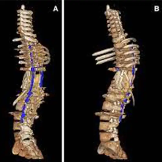 Ct Scanogram Spine In DLF Phase 2