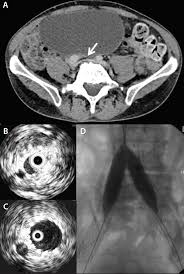 Ct Venogram Abdomen In DLF Phase 3