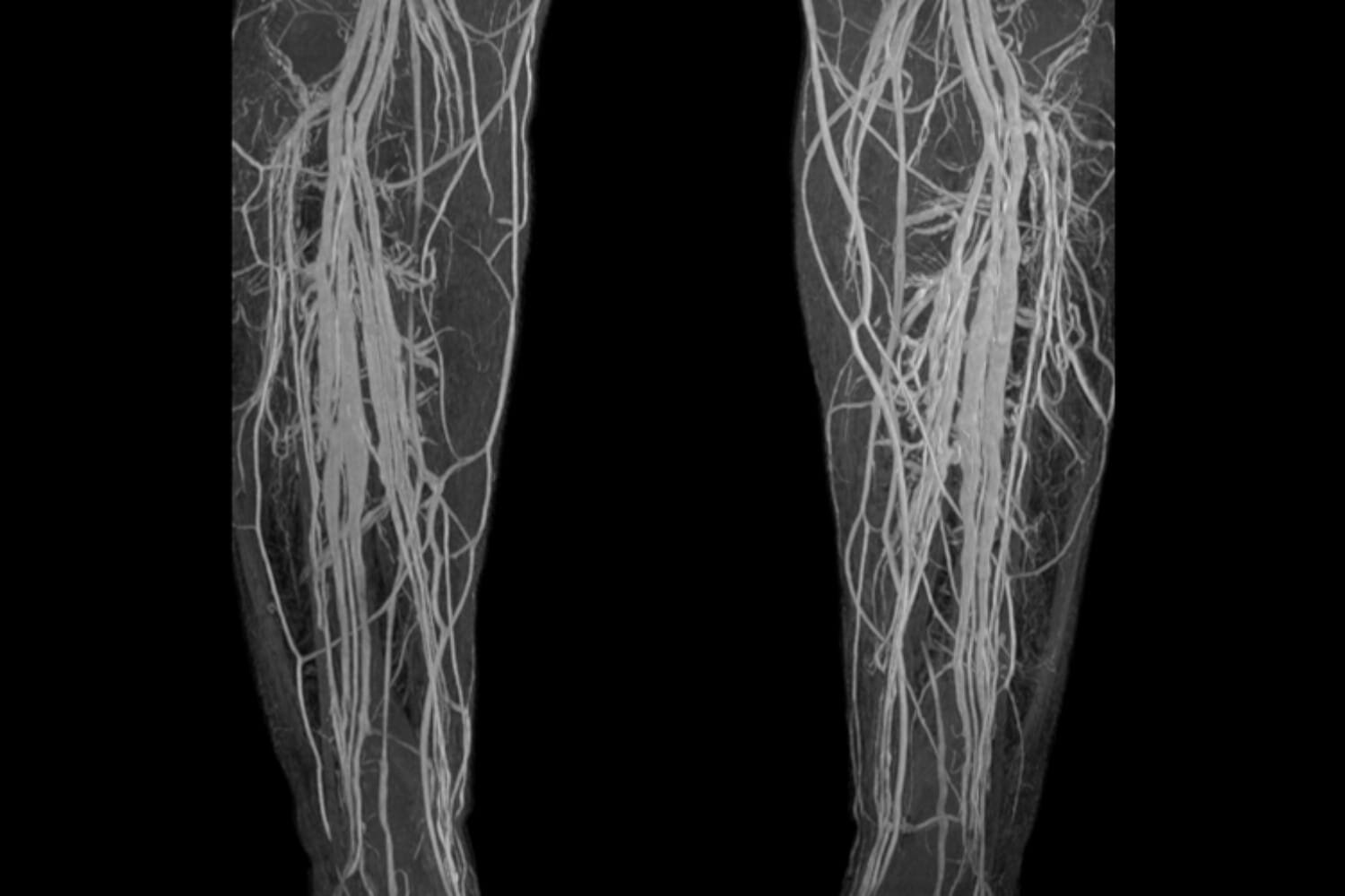 Ct Venogram Lower Abdomin& Bilateral Lower Limb In DLF Phase 3