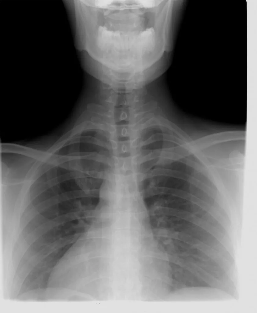 Hrct Chest Plain In DLF Phase 2