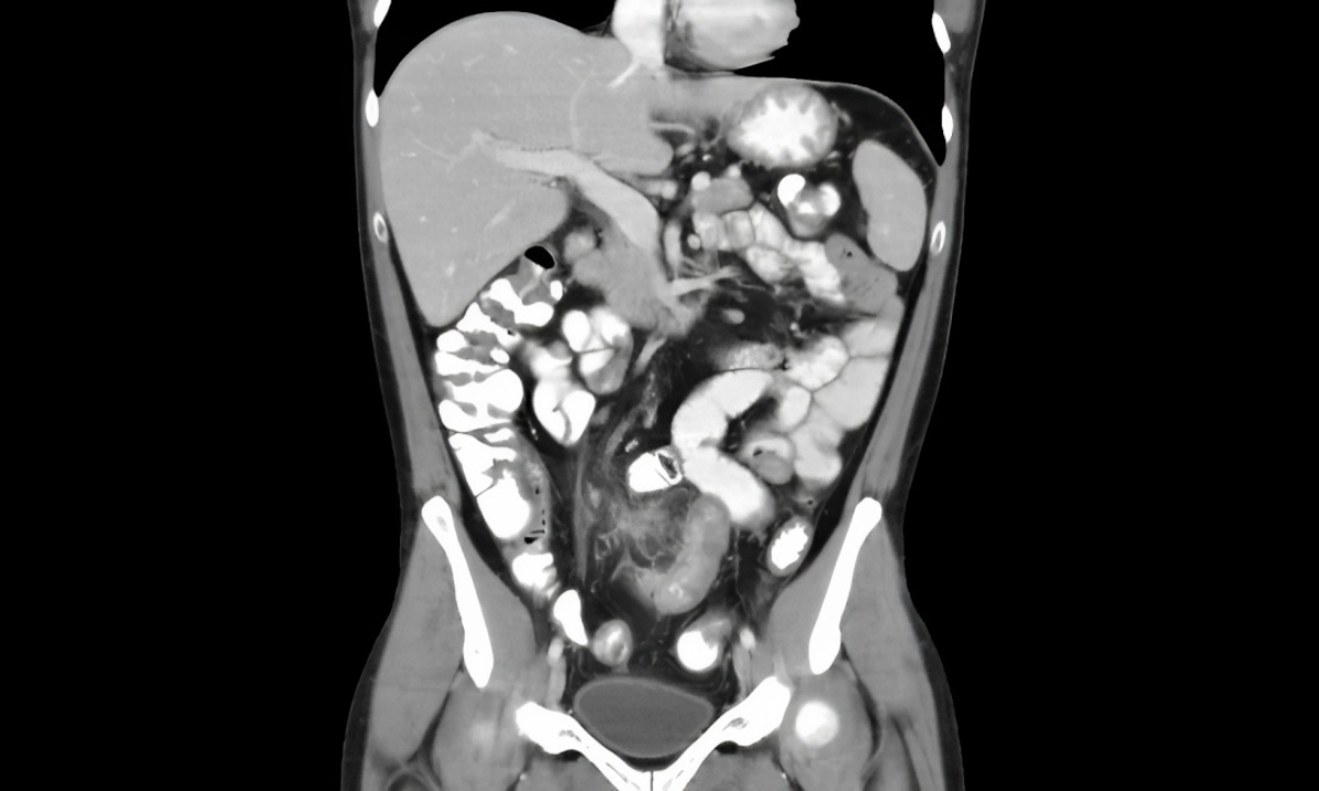 Ncct Abdomen Whole In DLF Phase 3