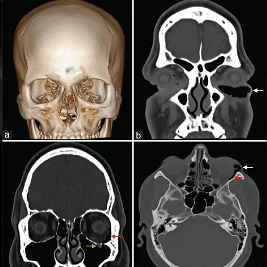 Ncct Face In DLF Phase 3