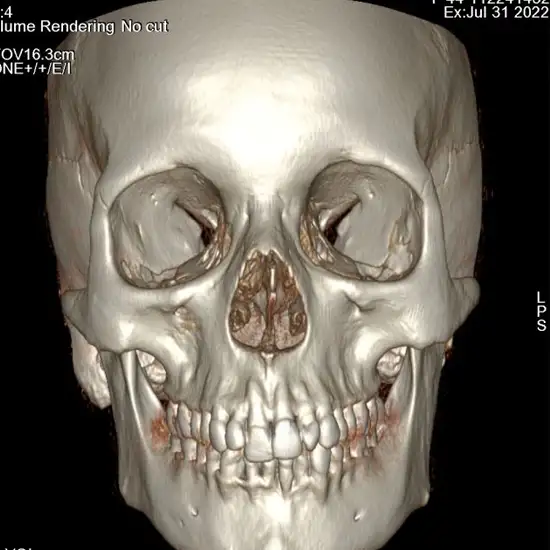 Ncct Face 3d In DLF Phase 3