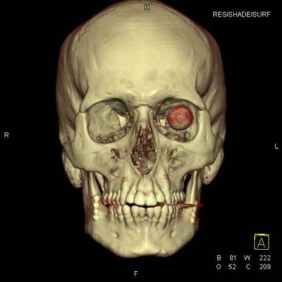 Ncct Head 3d In DLF Phase 2