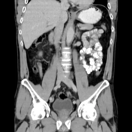 Ncct Hip Joint 3d In DLF Phase 2