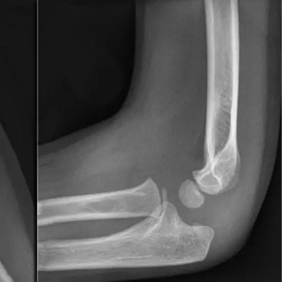 Ncct Left Elbow Joint In DLF Phase 2