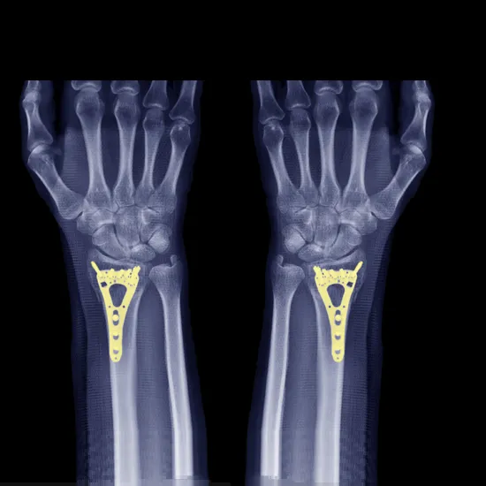 Ncct Left Hand In DLF Phase 3