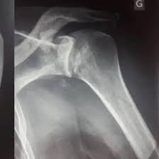 Ncct Left Shoulder Joint In Gurugram Sector 38