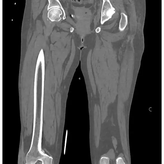 Ncct Left Thigh 3d In DLF Phase 2