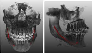 Ncct Mandible With 3d In DLF Phase 3