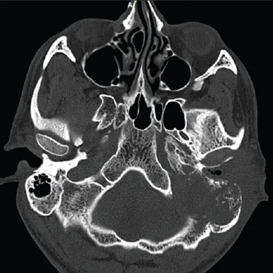 Ncct Mastoid In DLF Phase 2