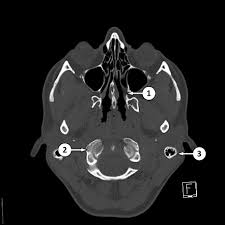 Ncct Mastoid Axial In Gurugram Sector 38