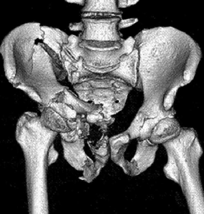 Ncct Pelvis 3d In DLF Phase 3